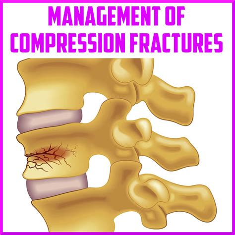 ball compression vertebral test|Diagnosing Vertebral Compression Fractures .